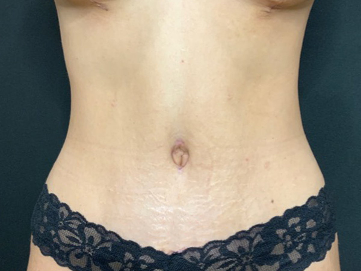 Case--6737 | After Breast Revision 2