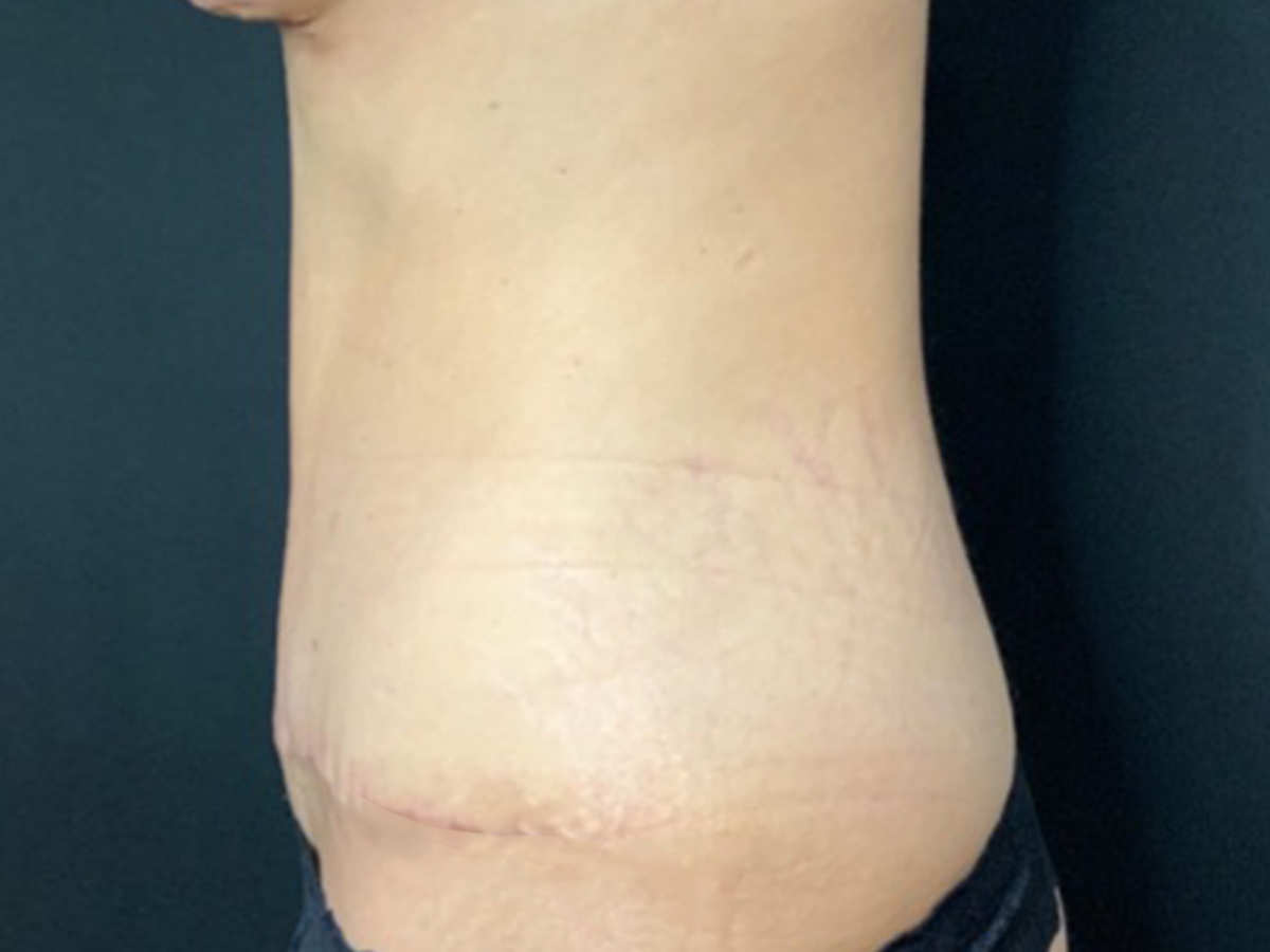 Case--6737 | After Breast Revision 4