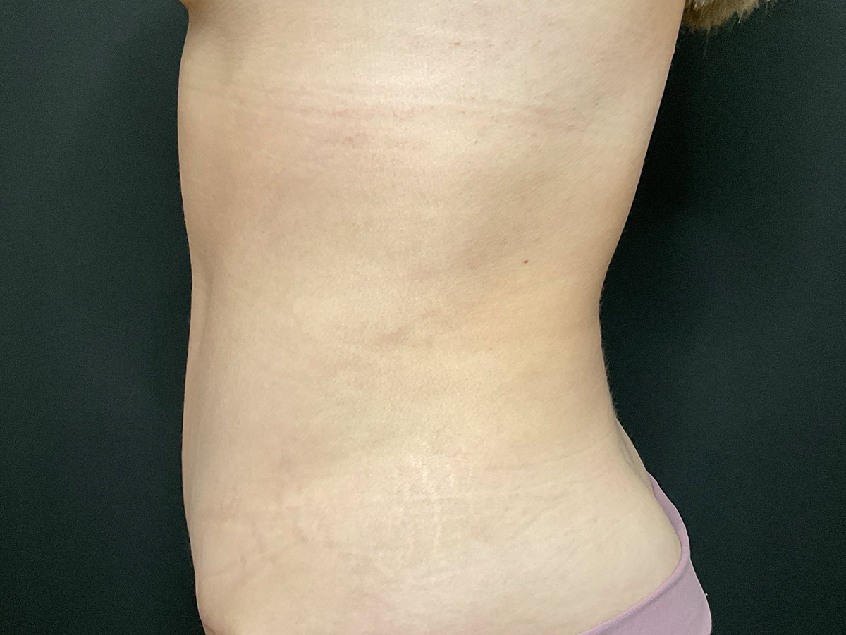 Case--8620 | After Tummy Tuck 2