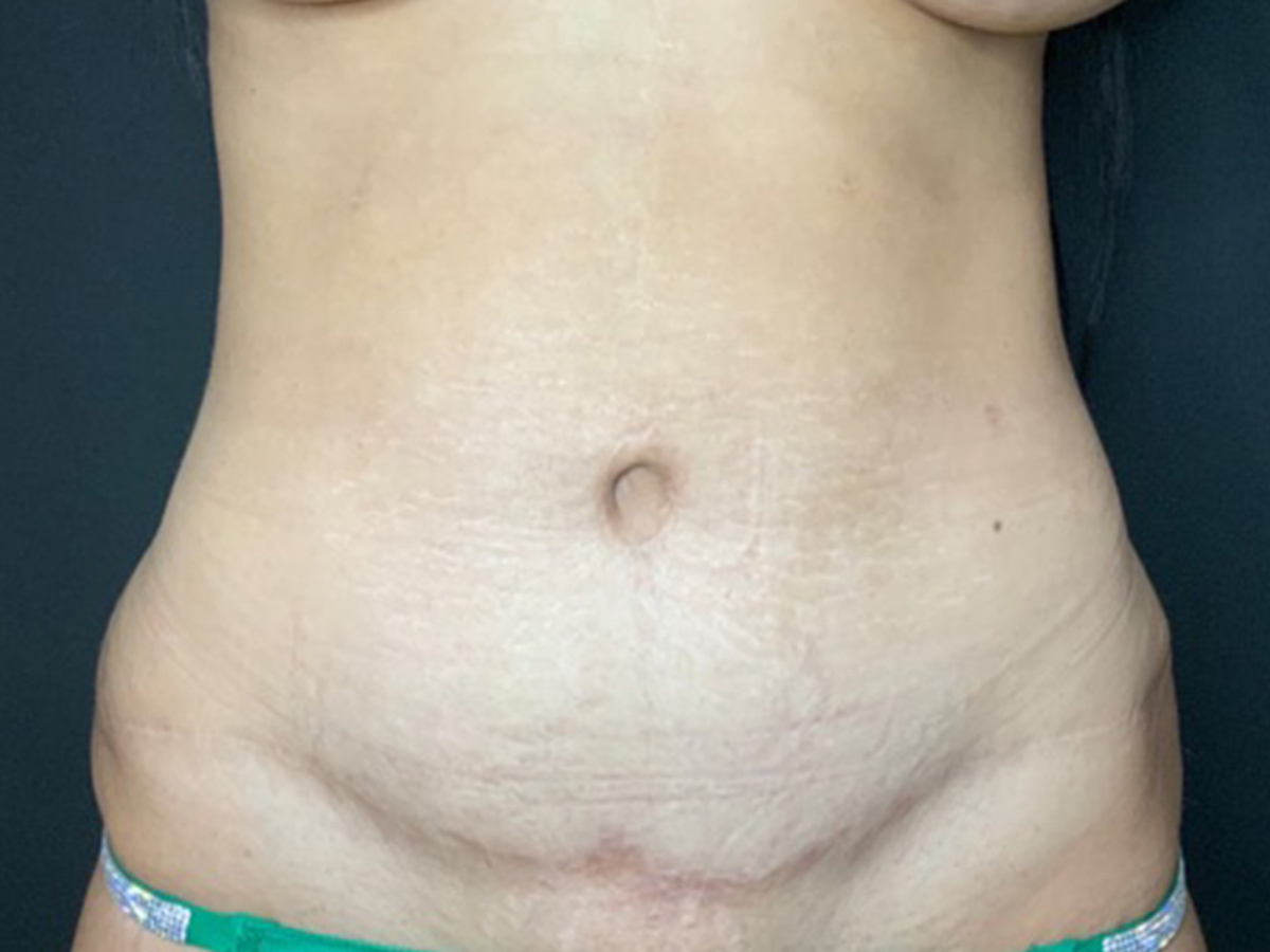 Case--6737 | Before Breast Revision 2