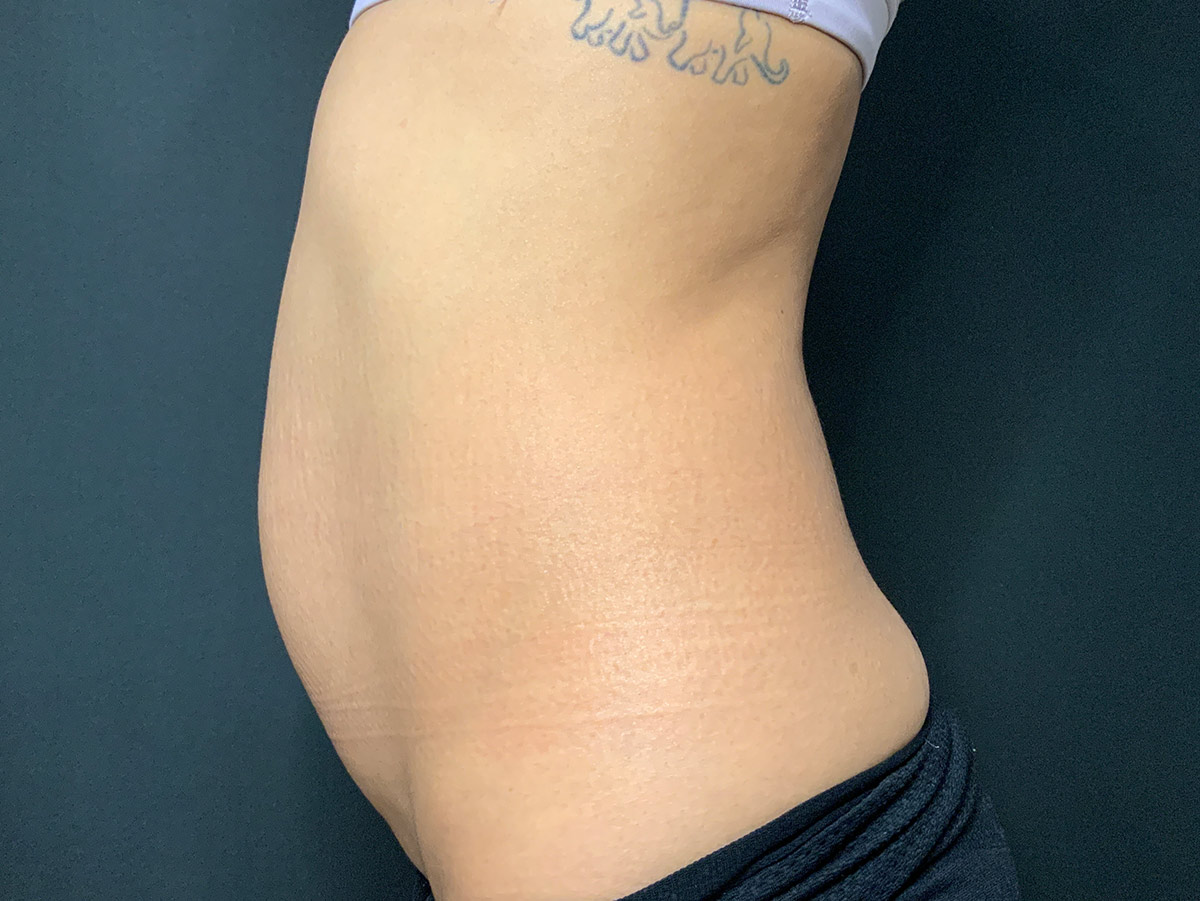 Case--6587 | Before Liposuction 3