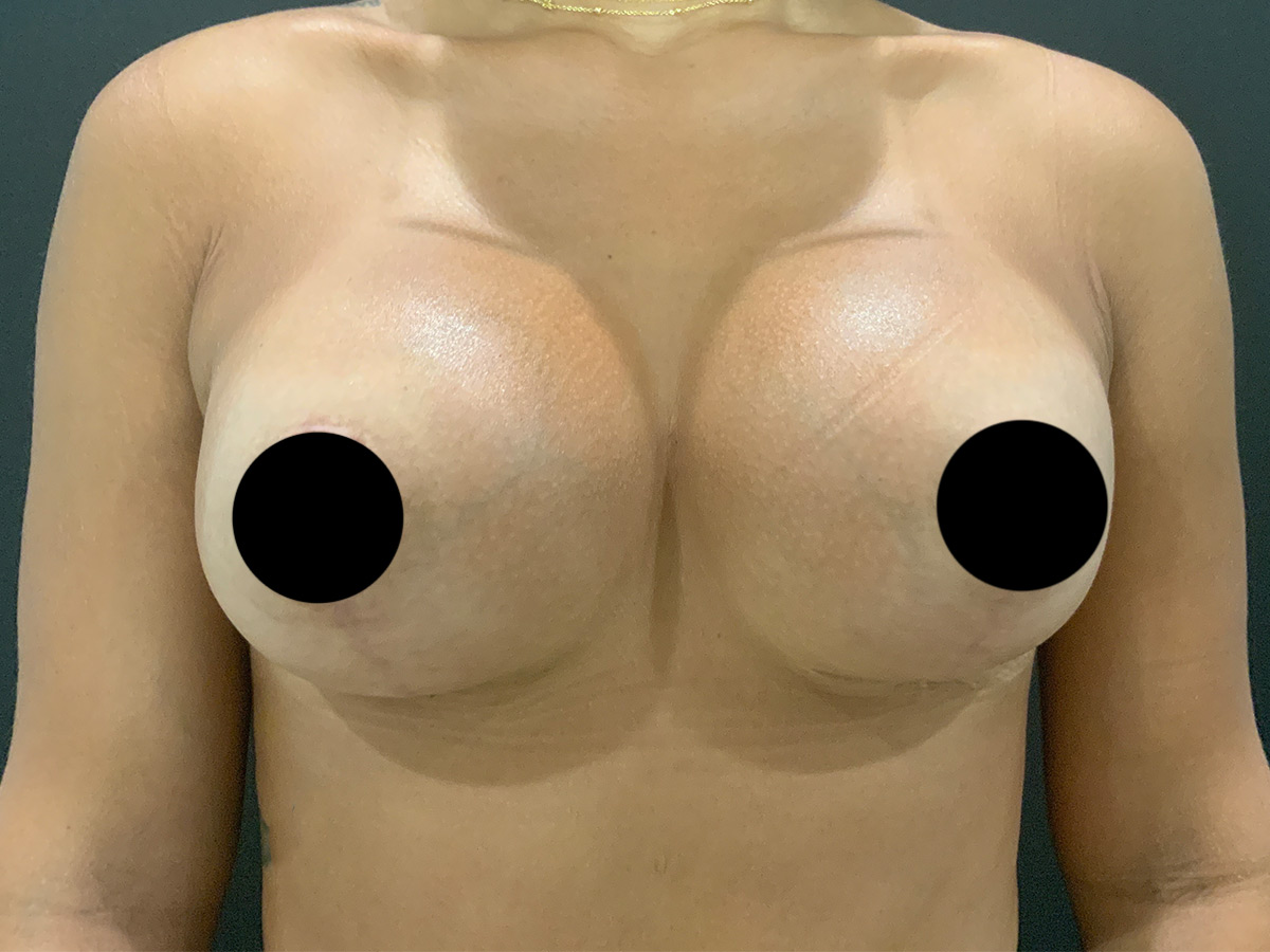 Case--2278 | After Breast