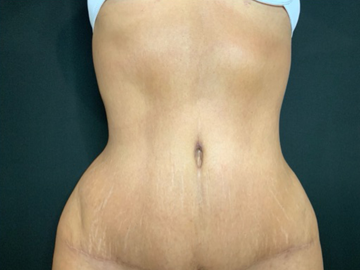 Case--2699 | After Tummy Tuck