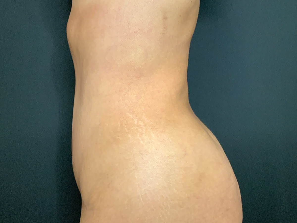 Case--2699 | After Tummy Tuck 2