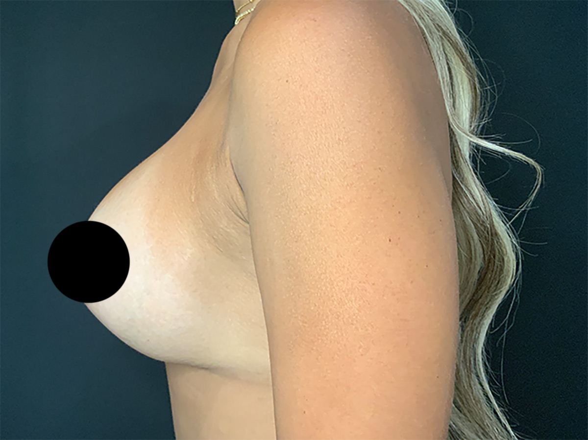 Case--2278 | Before Breast Revision 2