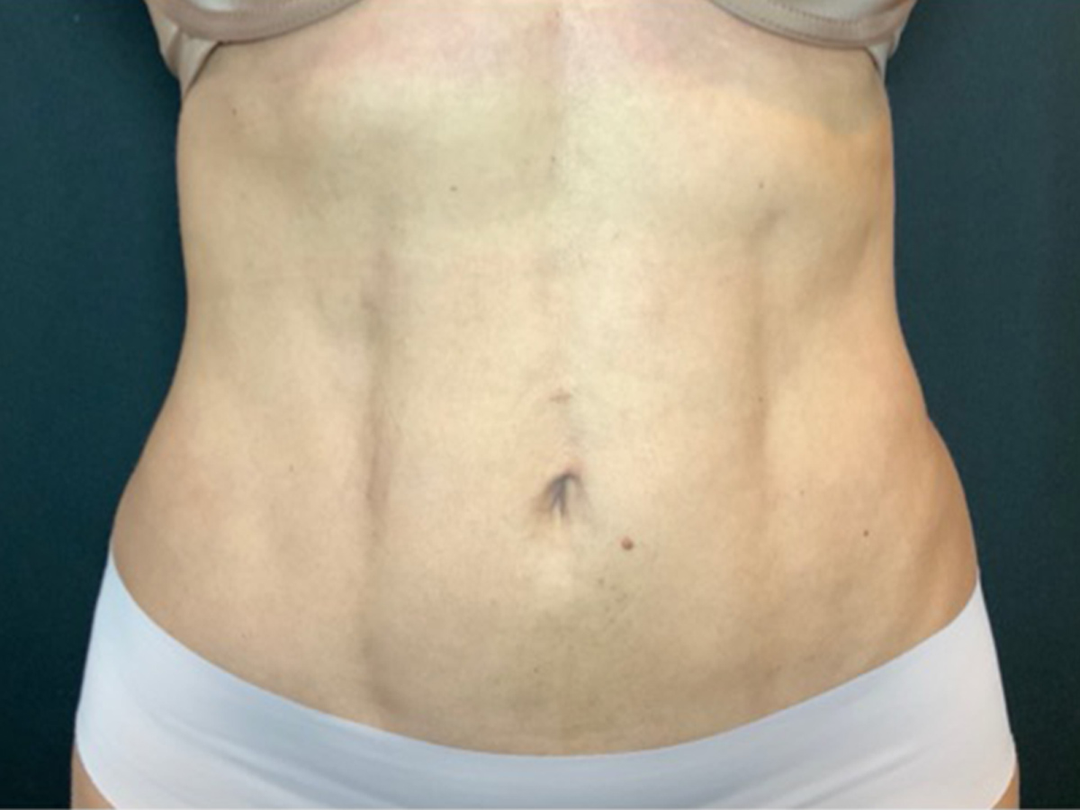 Case--1706 | After Body