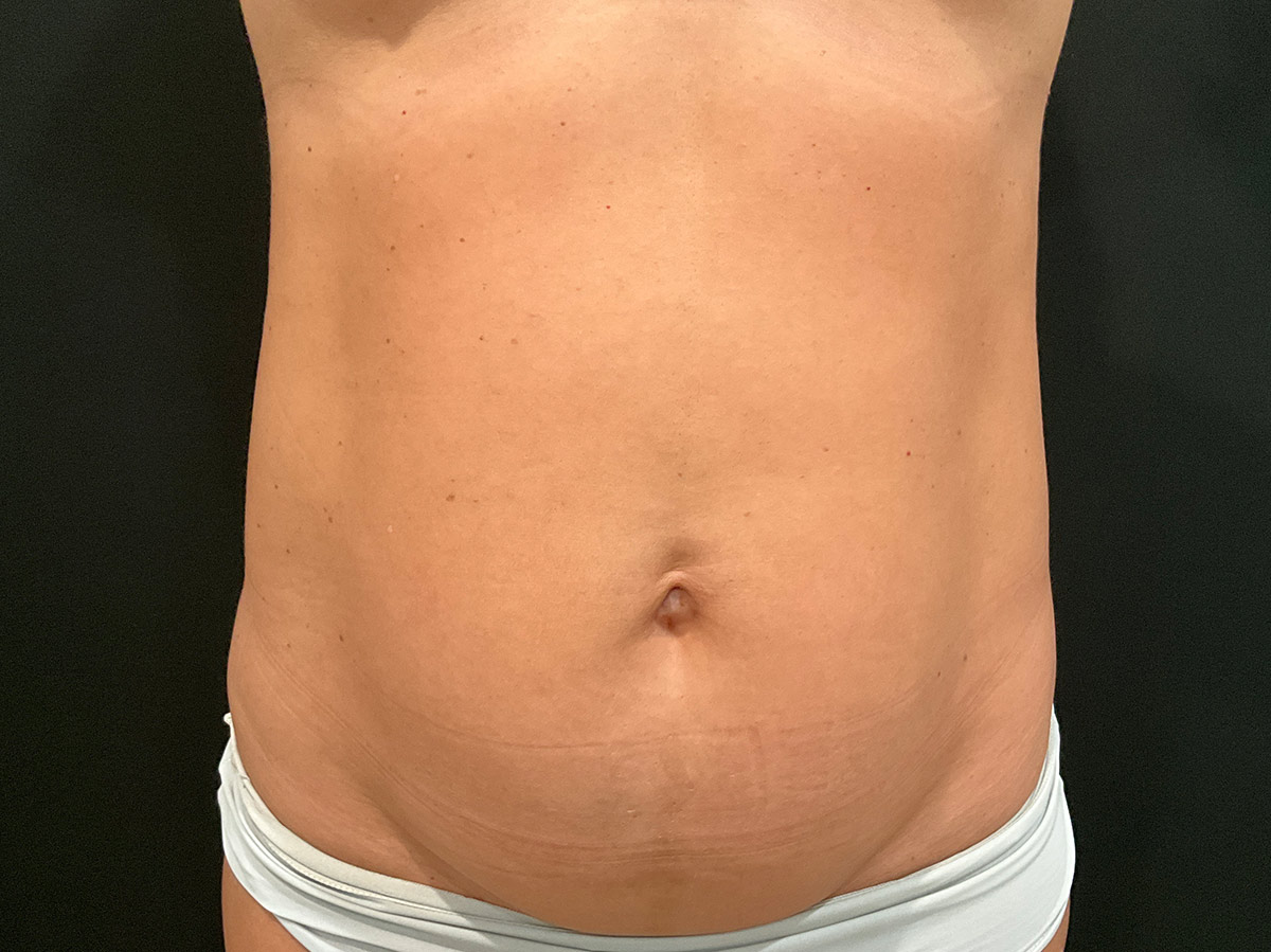 Case--2815 | Before Tummy Tuck