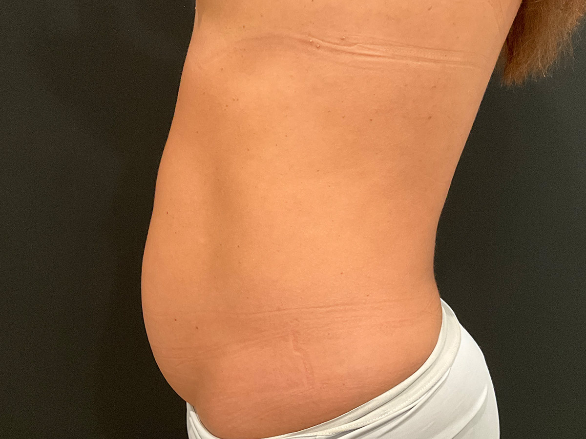 Case--2815 | Before Tummy Tuck 2