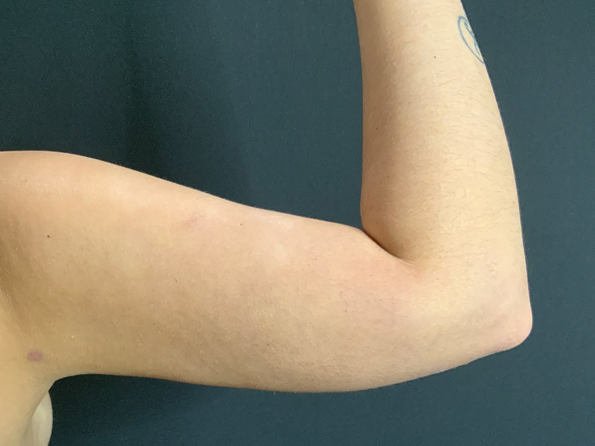 Liposuction to Arms
