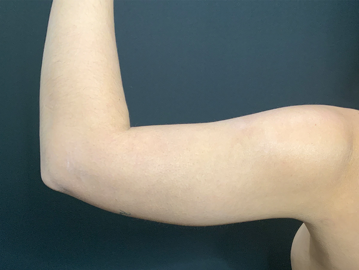 Liposuction to Arms